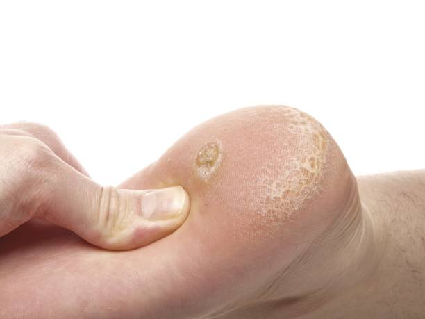Pressure Ulcers: The Bedsores That Prove Nursing Home Neglect